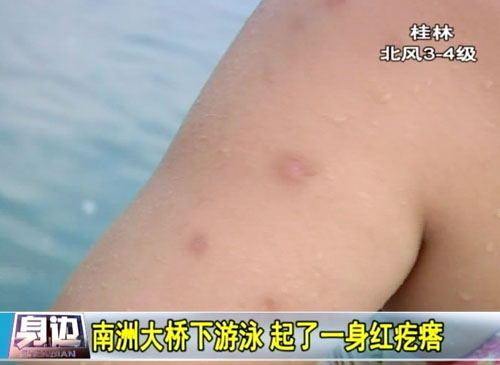南洲大桥下游泳起了一身红疙瘩